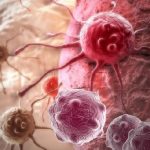 جوان افراد میں تیزی سے عام ہونیوالے آنتوں کے کینسر کی 5 علامات جانیں